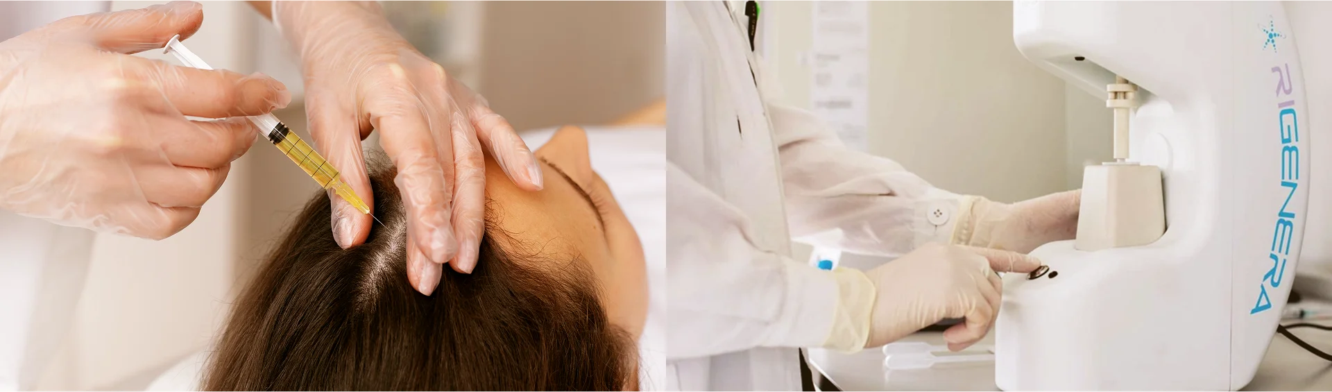 Regenera Activa Treatment vs PRP Therapy: Which One Is More Effective for Hair Regrowth?