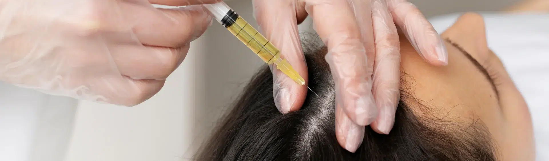 PRP vs. GFC: Which Is the Better Hair Fall Treatment in Gurugram?