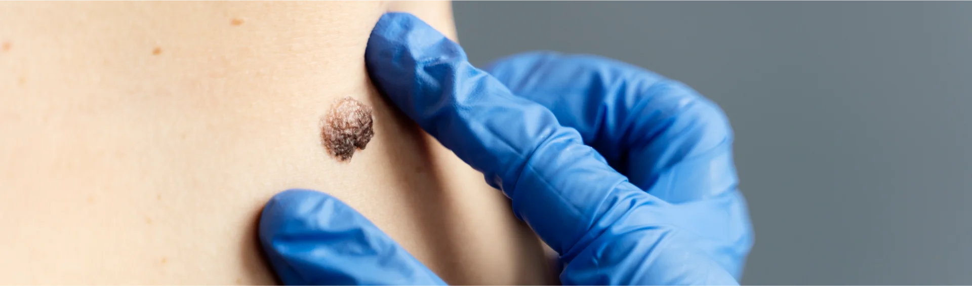 Bye-Bye Bumps: Gurugram’s Go-To Clinic for Getting Rid of Skin Tags, Moles