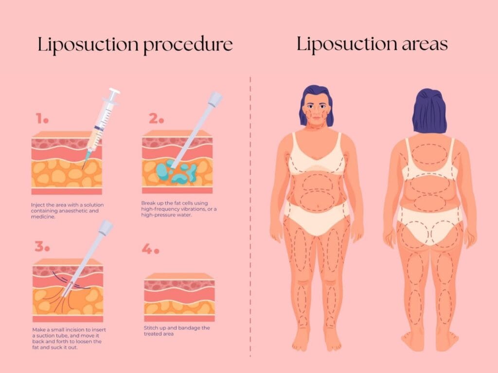 Liposuction Surgery Procedure and Areas
