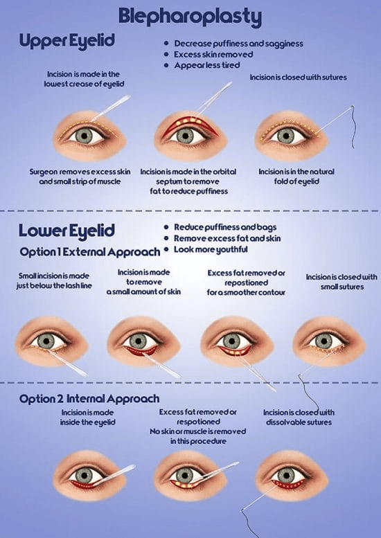 Blepharoplasty