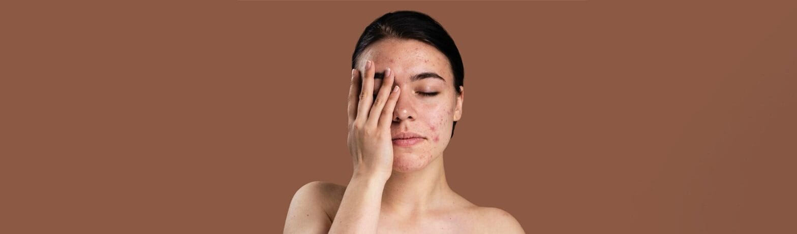 effective acne scars treatment