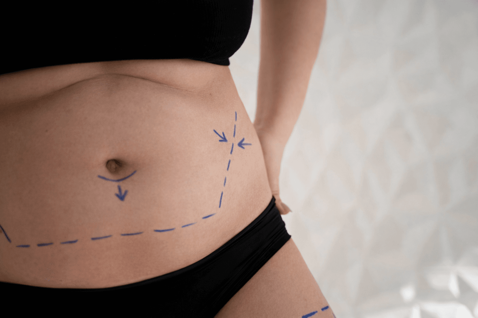 Body Contouring: How Liposuction Shapes Your Body
