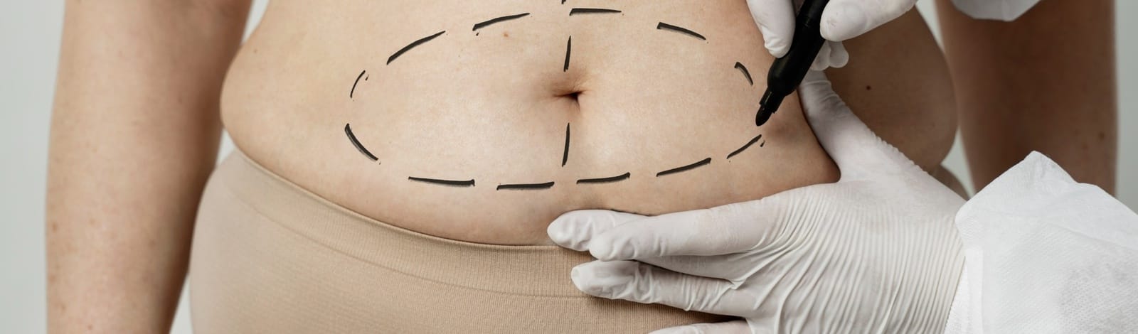 Tummy Tuck vs. Mommy Makeover: Which Is Right for You in Gurgaon?