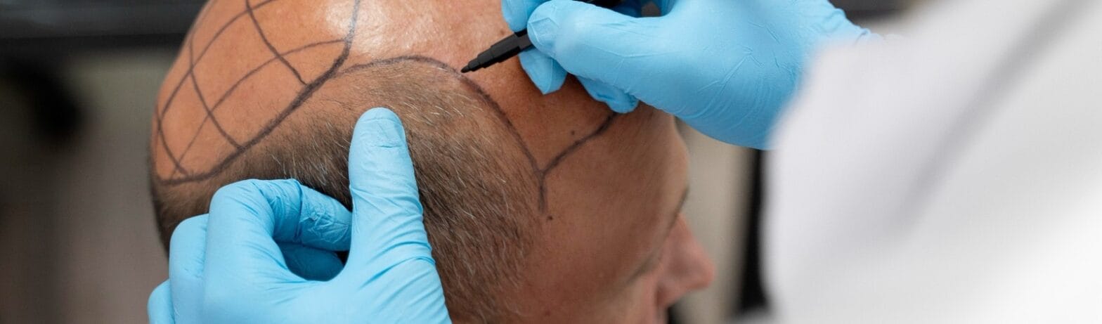 best hair transplant option in india