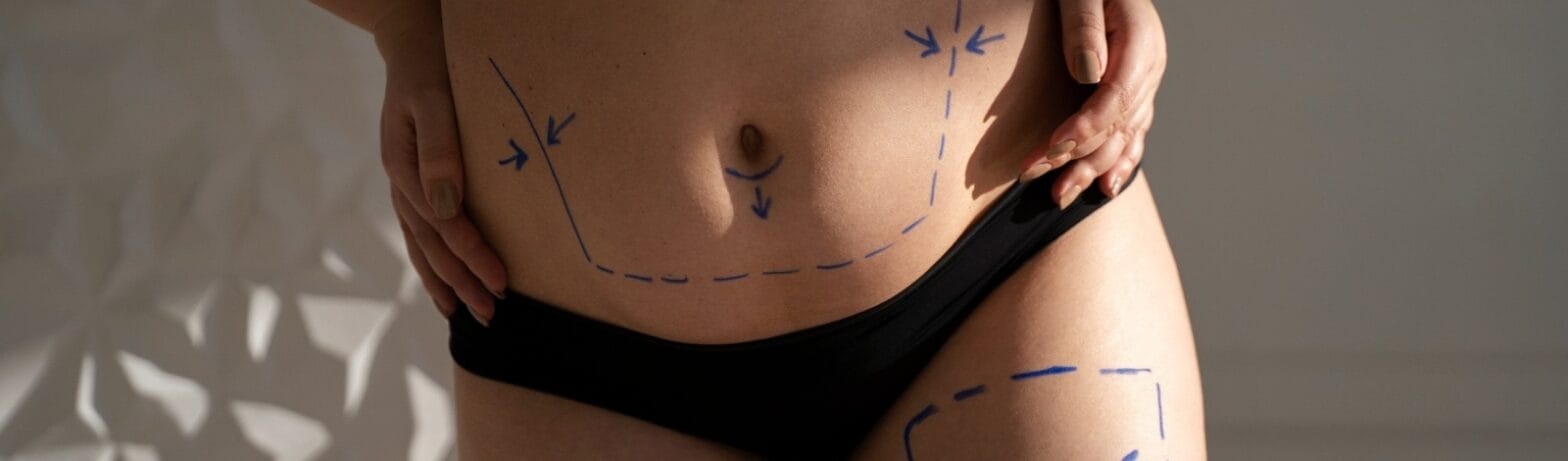 woman body with mommy makeover