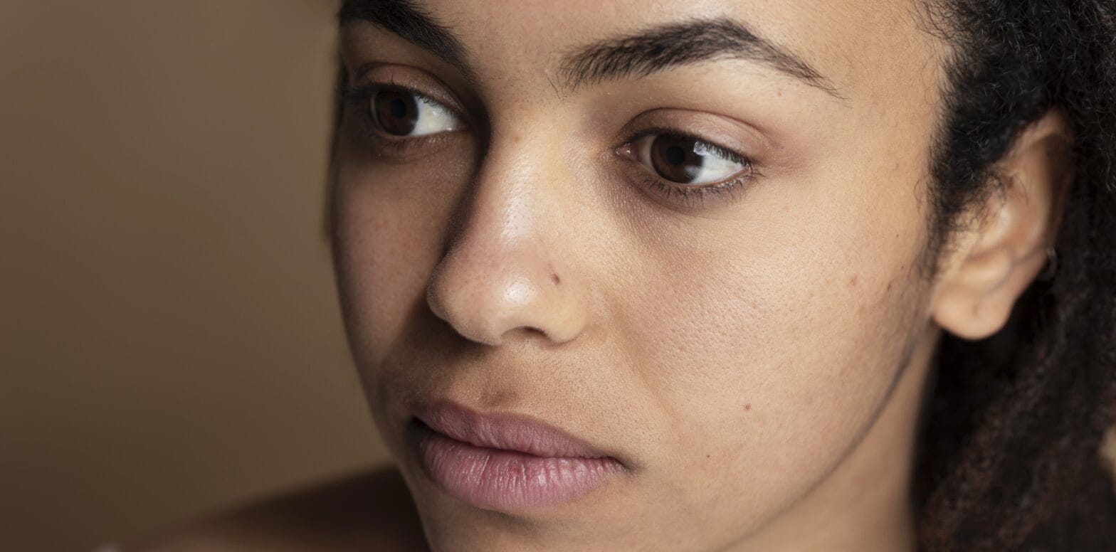 acne scars mistakes to avoid