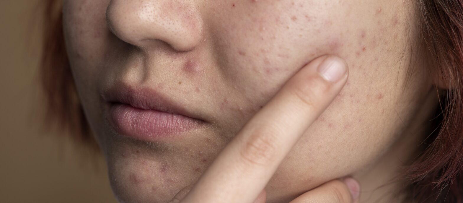 subcision with biofiller and microneedling with exosomes