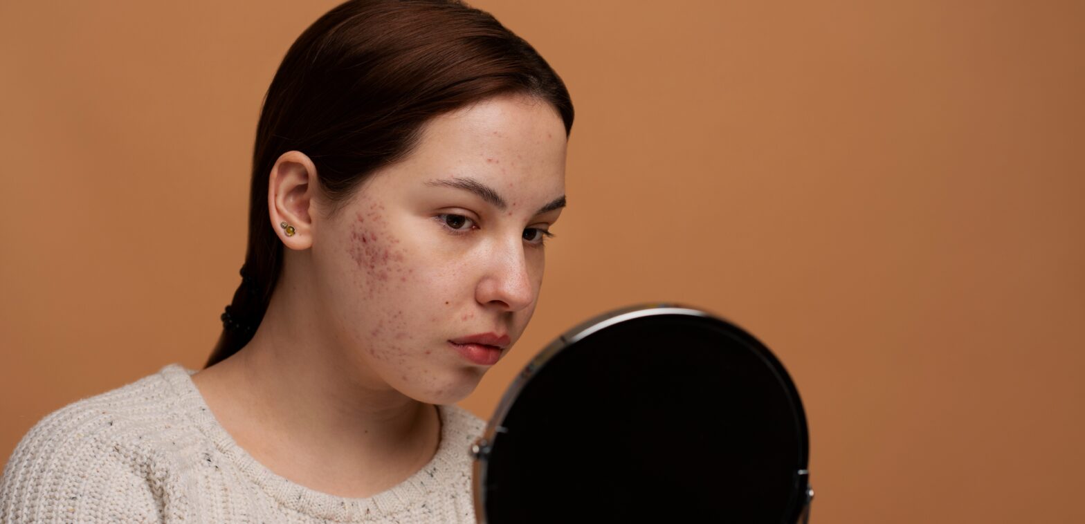 tethered acne scars