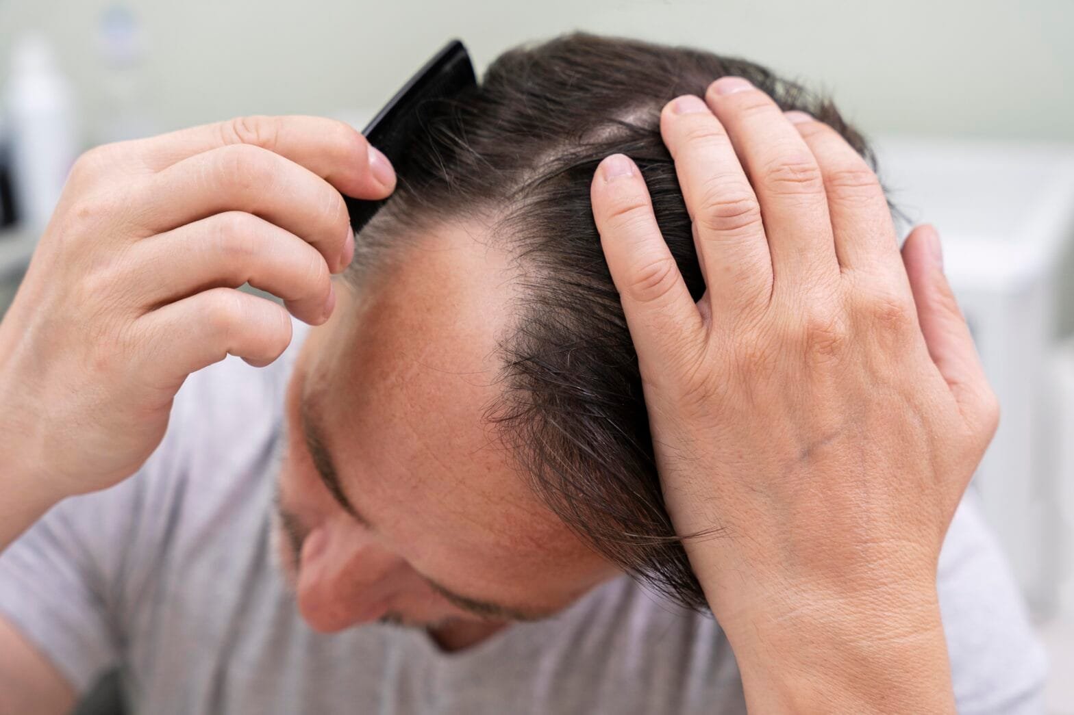 Hair Transplant in Gurgaon for NRIs