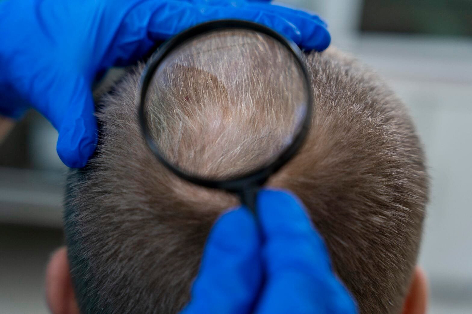 nris hair transplant comparison