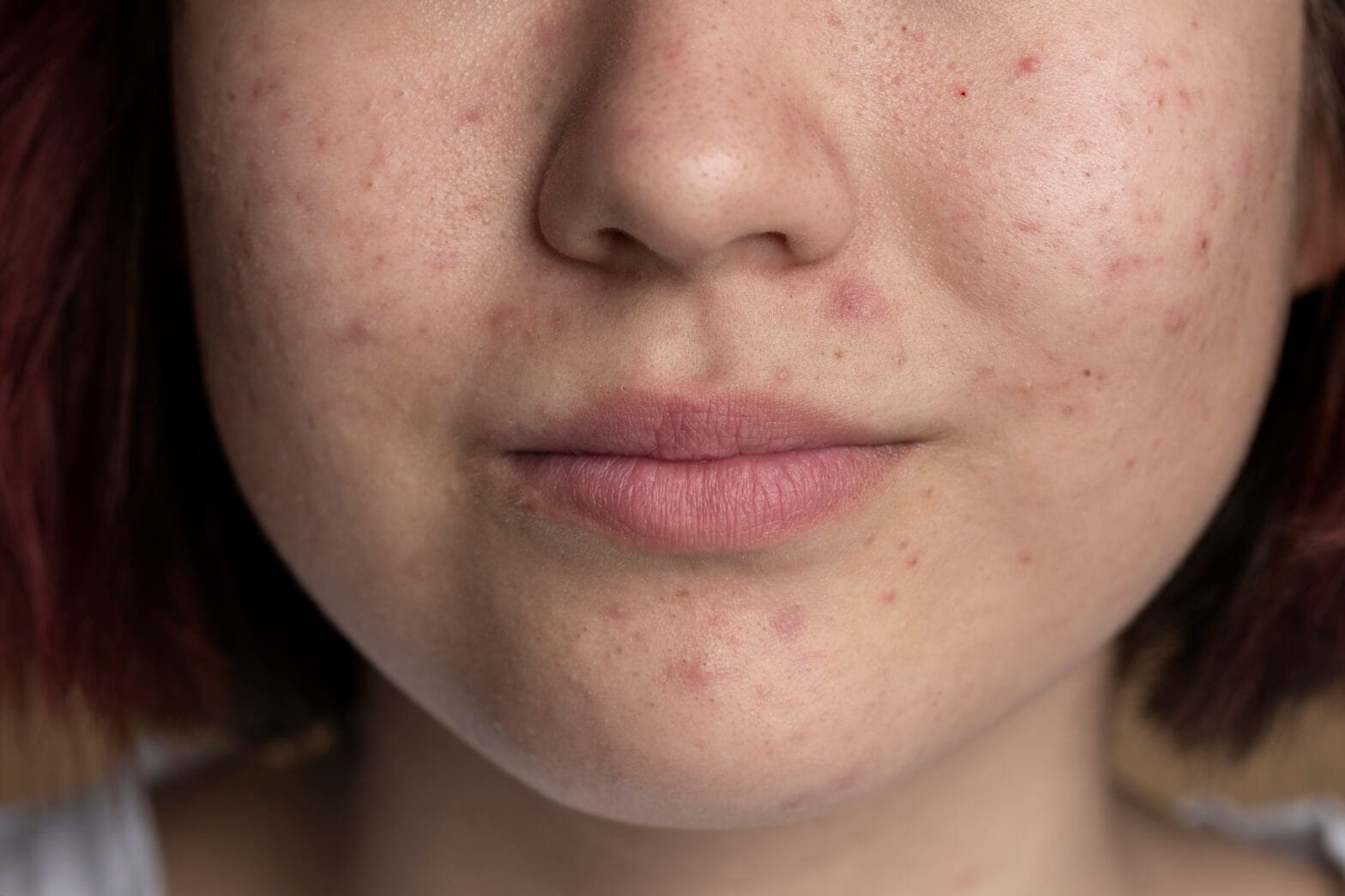PRP vs. GFC for Acne Scars in Gurgaon